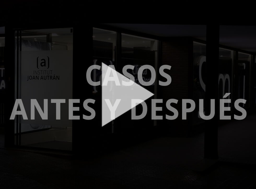 Edición de Vídeos - Casos Antes y después carillas (AUTRÁN)