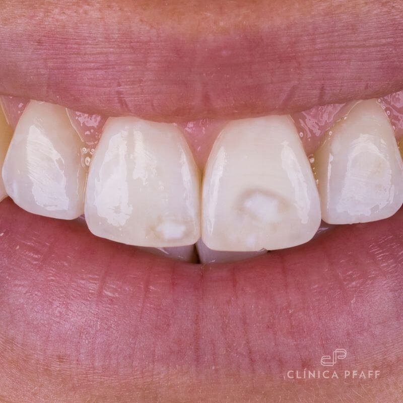 Cómo es el tratamiento de carillas dentales - Clínica Pfaff
